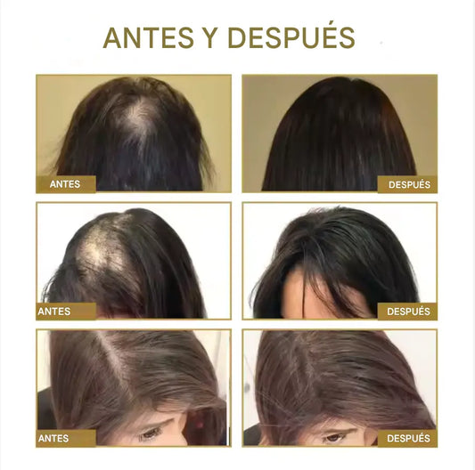 Aceite natural Vegamane I Tratamiento para el crecimiento del cabello donde ya no lo hay 🔥 Solo por hoy 50% de dcto